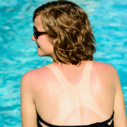 woman with sunburn by pool