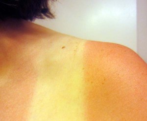 Stop sunburn pain: BrownThumbMama.com