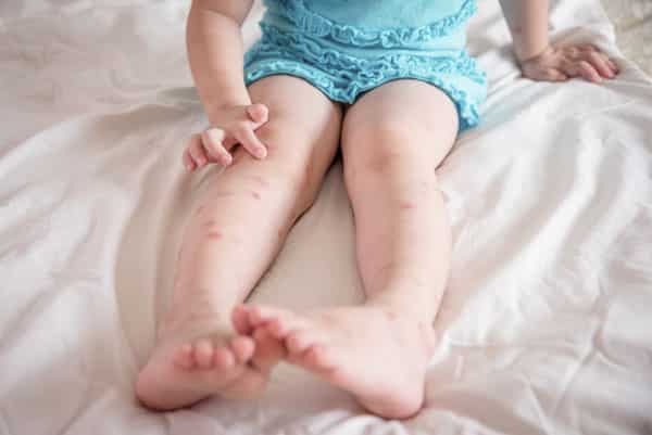 toddler in blue dress with legs covered in bug bites