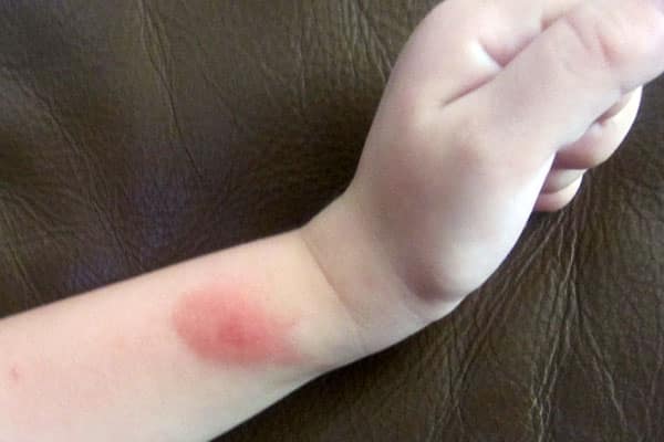 bug bite on baby's arm